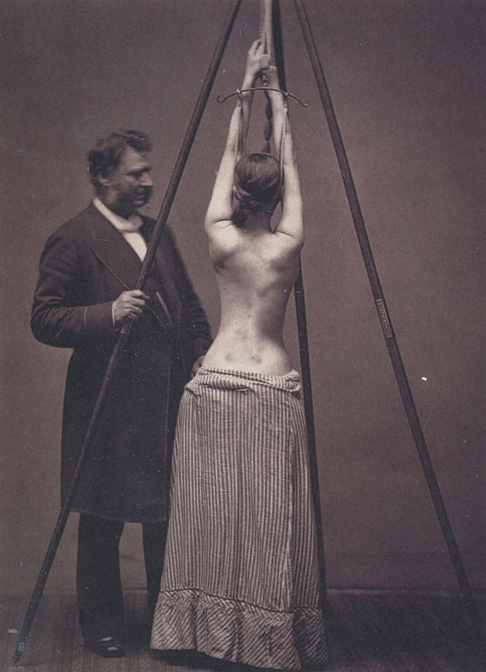 Lewis Sayre’s scoliosis treatment, 1877.jpg